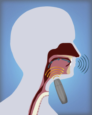 نمایش تاثیر حنجره مصنوعی الکتریکی